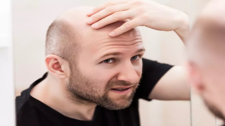Aging, Hair Loss, and 5 Effective Treatments