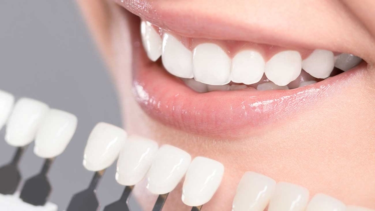 Teeth Whitening Side Effects: Are there Any?