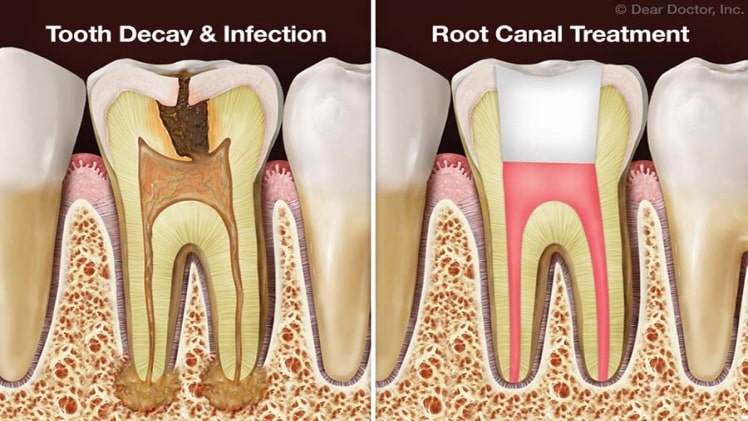 Why Root Canal Therapy Is Not Recommended