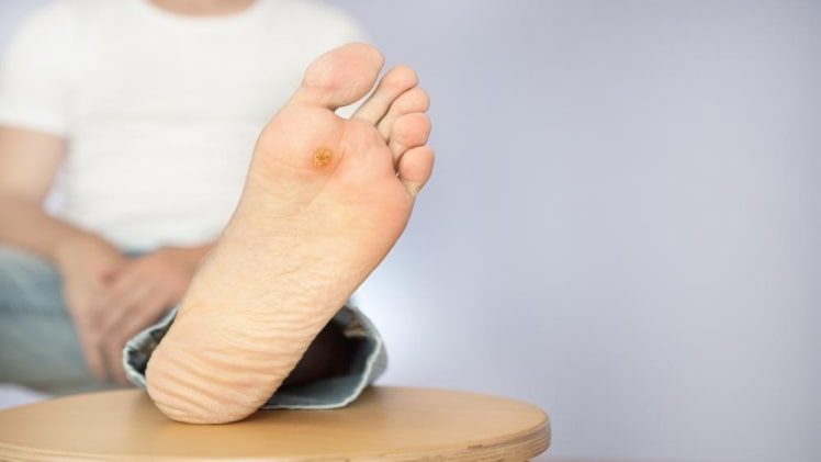 Everything You Need to Know About Diabetic Foot Ulcer
