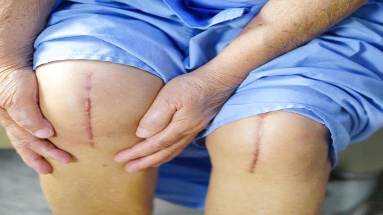 Total knee arthroplasty
