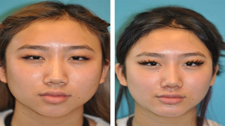 Chin reconstruction surgery