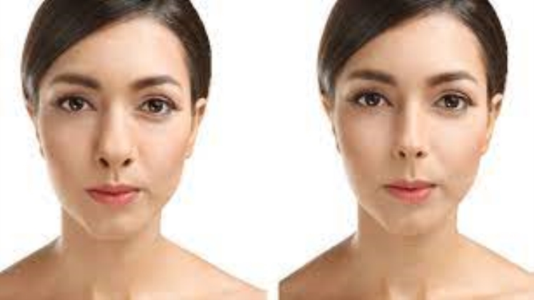 The Benefits of Getting a Nose Job