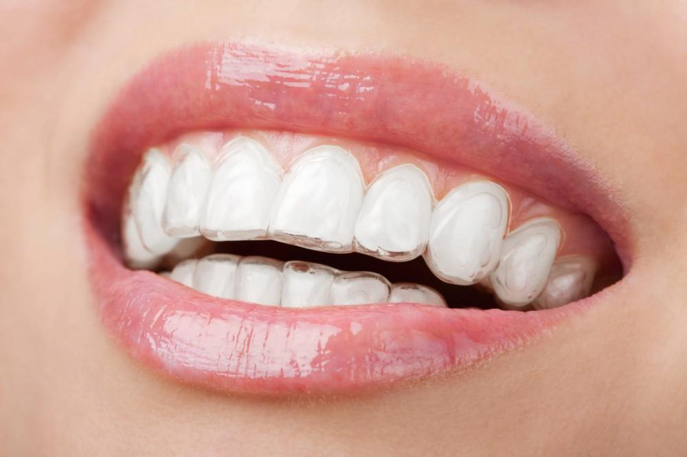 Easy Methods To Keep Your Invisalign Aligners In Top Shape